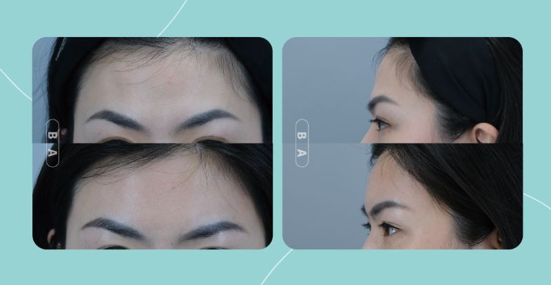 Aesthefill 艾麗斯實際案例照片