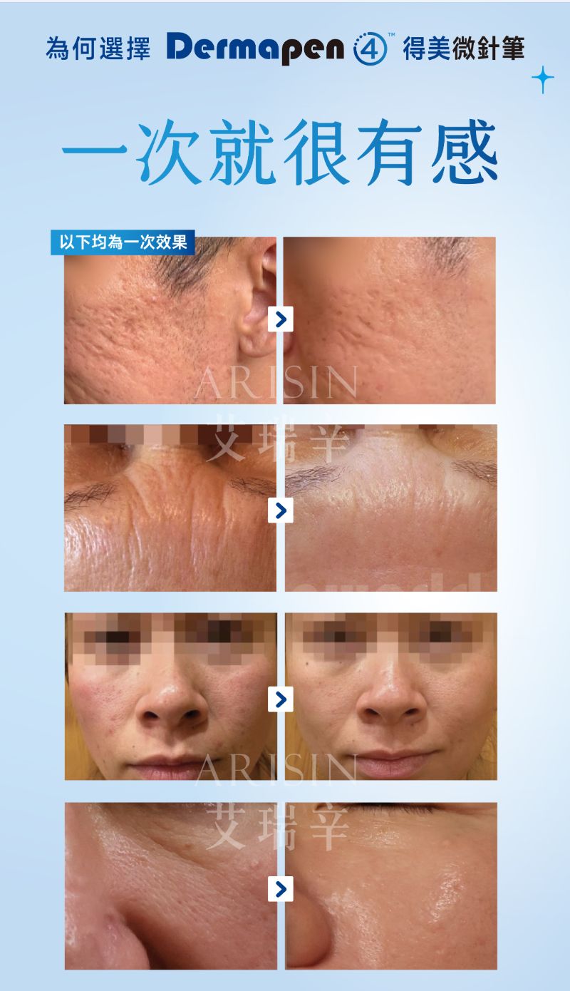 Dermapen 4 得美微針筆案例照片