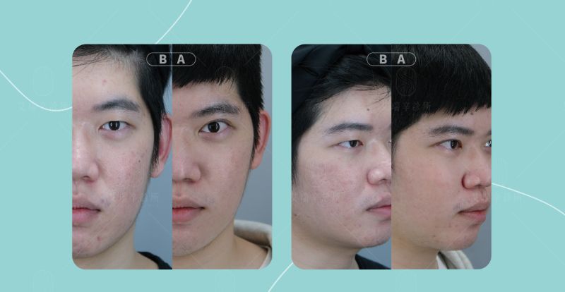 Discovery Pico 探索皮秒雷射2