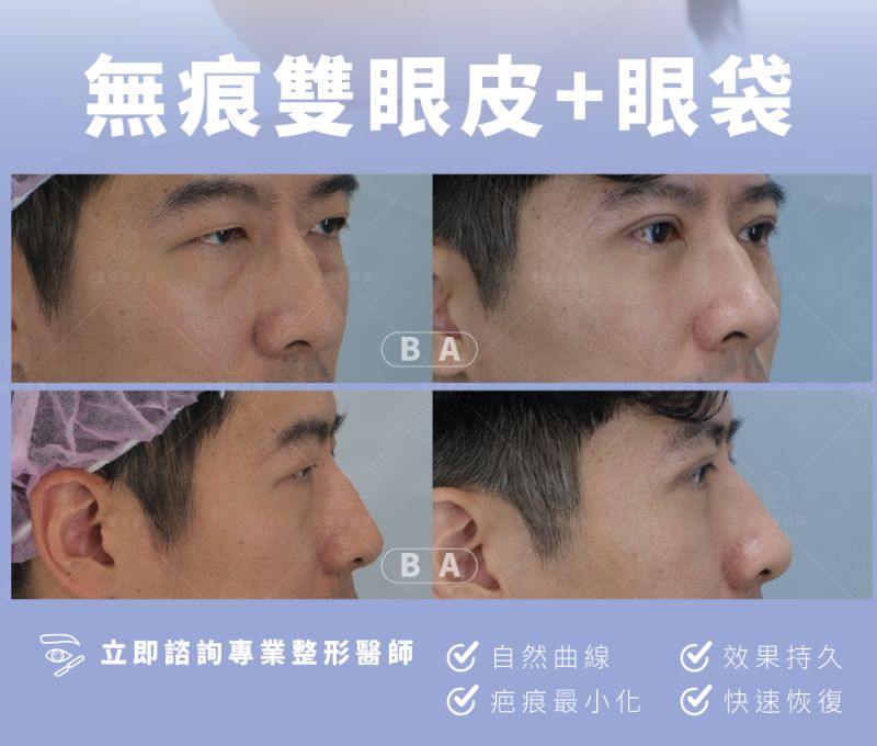 Eye Surgery雙眼皮1