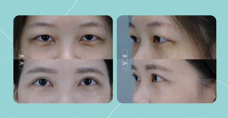 Eye Surgery雙眼皮2