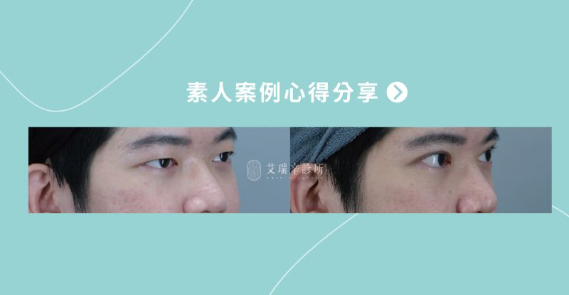 Eye Surgery雙眼皮3