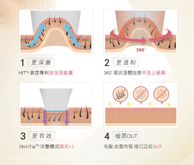 LightSheer第三代真空除毛1
