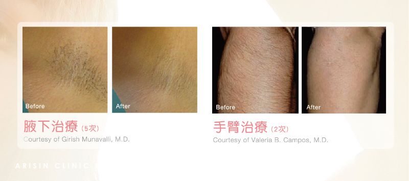 LightSheer第三代真空除毛6