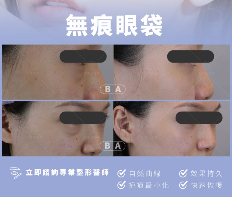 Lower Blepharoplasty 眼袋手術5