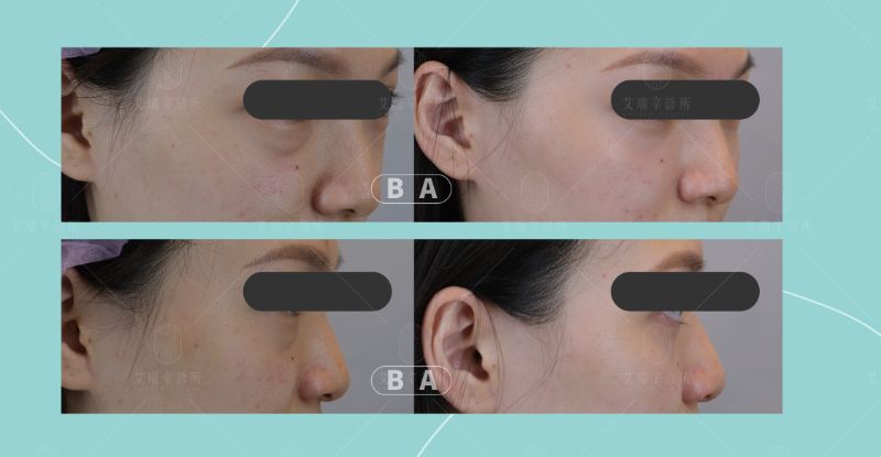 Lower Blepharoplasty 眼袋手術１