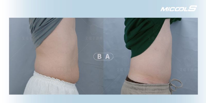 MICOOL-S 冷凍減脂實際案例照