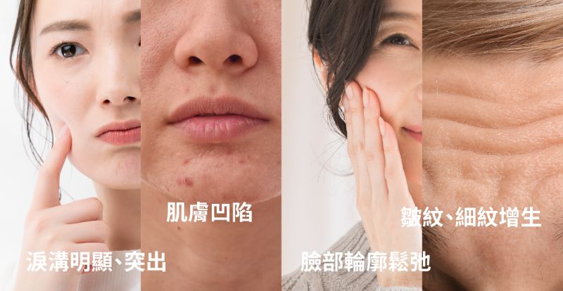 Neuramis 仙女玻尿酸介紹 3