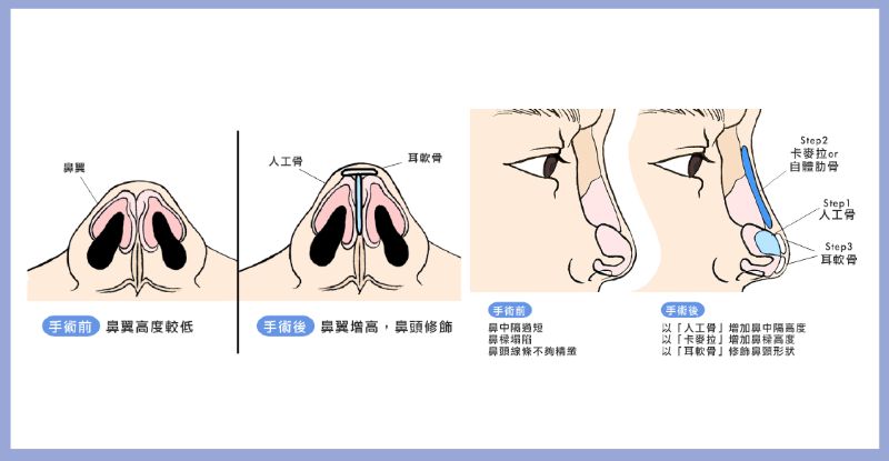 Nose Surgery 隆鼻3
