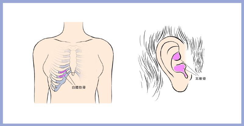 Nose Surgery 隆鼻4