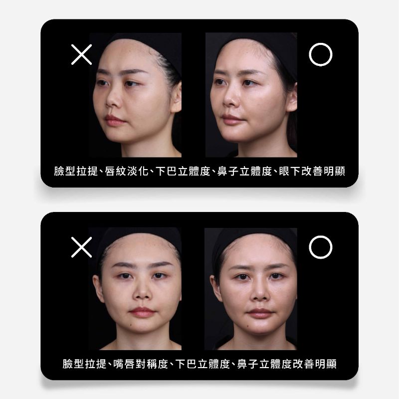 Restylane瑞絲朗玻尿酸 介紹 7