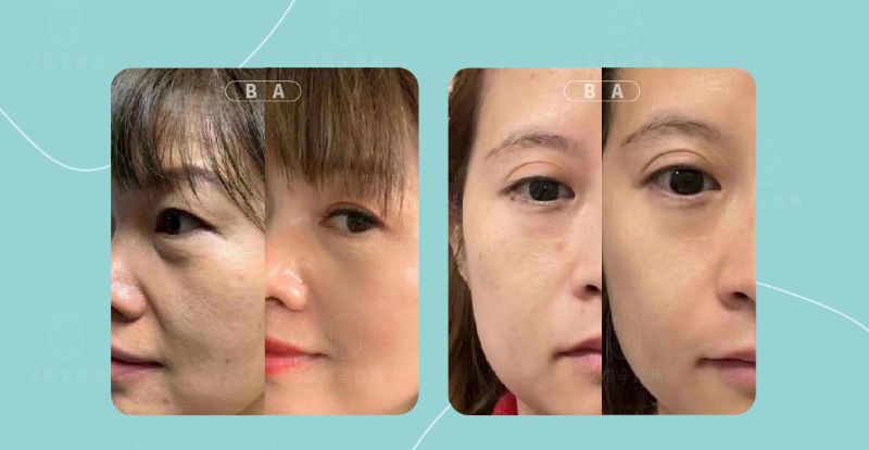 Vital Injector2 水光注射器5