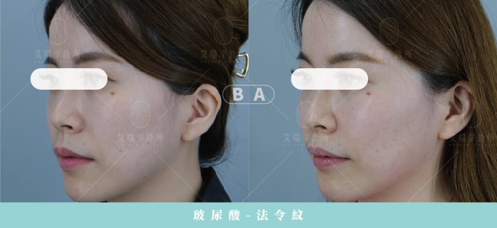 Restylane 瑞絲朗玻尿酸案例照片