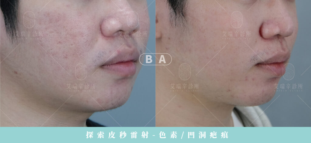 痘疤治療BA照片