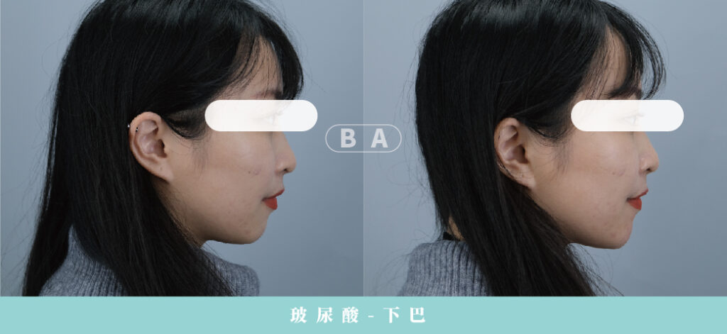Restylane 瑞絲朗玻尿酸案例照片