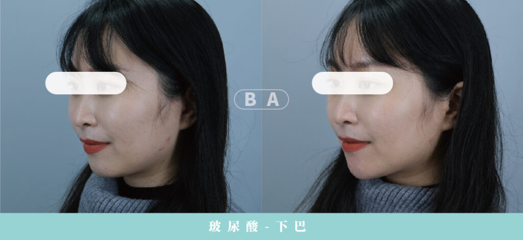 Restylane 瑞絲朗玻尿酸案例照片