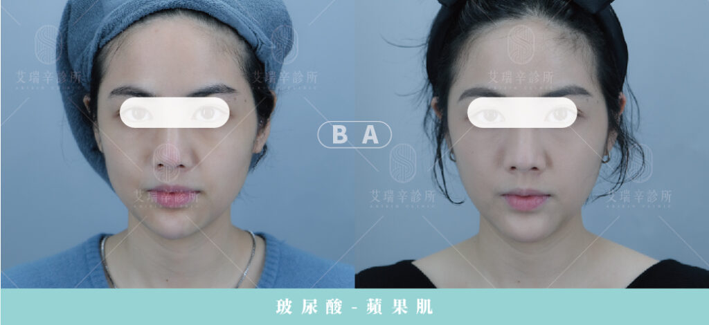 Restylane 瑞絲朗玻尿酸案例照片