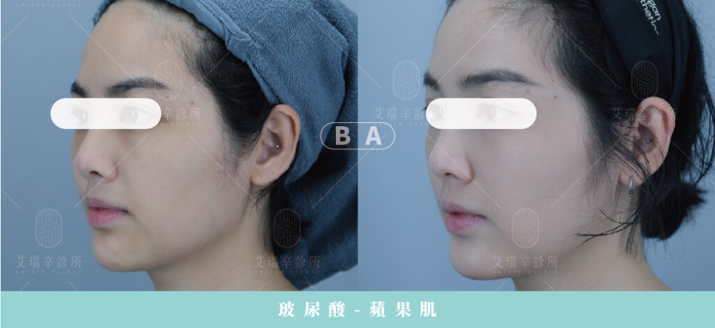 Restylane 瑞絲朗玻尿酸案例照片