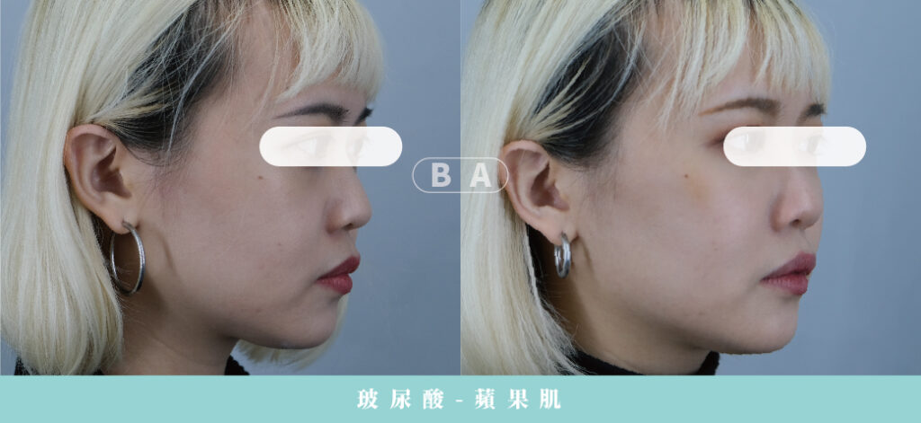 Restylane 瑞絲朗玻尿酸案例照片