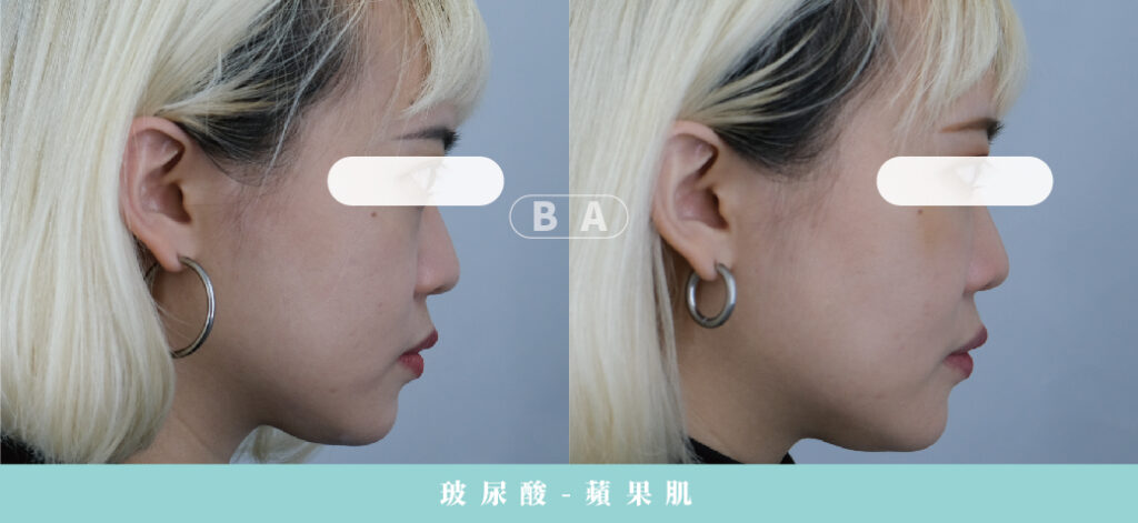 Restylane 瑞絲朗玻尿酸案例照片
