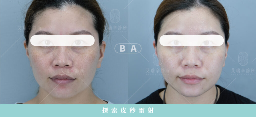 艾瑞辛診所 Discovery Pico 探索皮秒雷射實際案例照片2