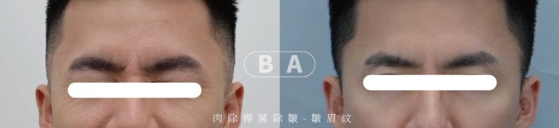 艾瑞辛診所 肉毒實際案例照片 (2)