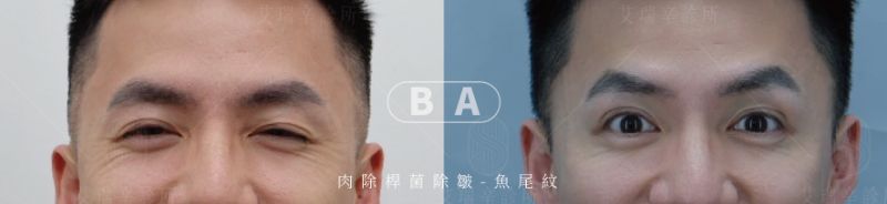 艾瑞辛診所 肉毒實際案例照片(1)