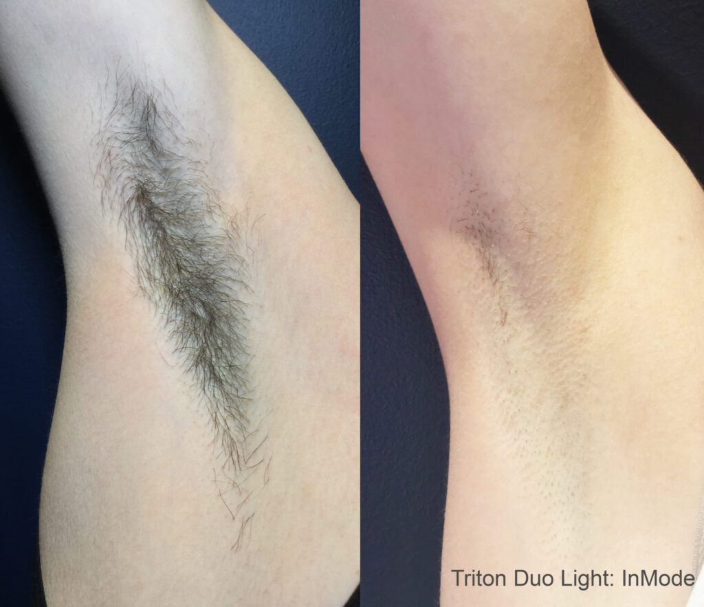 TritonDuoLight 1tx NoShaving3Weeks scaled 3