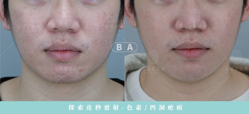 台中痘疤醫美推薦:療程比較、治療過程與選診所指南 10 image 1