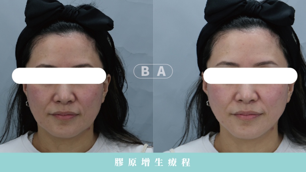 臉下垂怎麼辦?原因、判斷方式與全方位改善攻略 16 玻尿酸&膠原蛋白增生劑