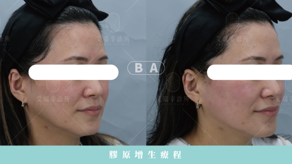 臉下垂怎麼辦?原因、判斷方式與全方位改善攻略 17 玻尿酸&膠原蛋白增生劑