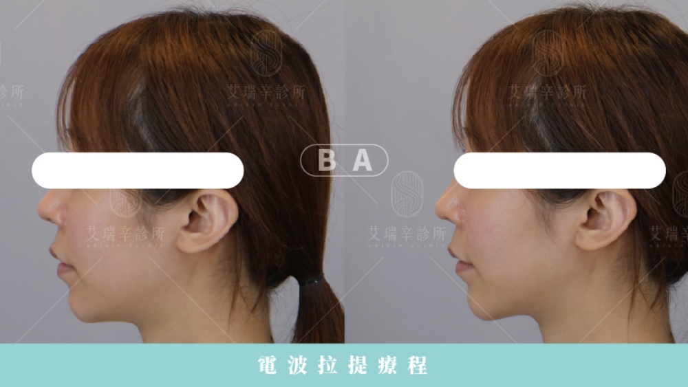 臉下垂怎麼辦?原因、判斷方式與全方位改善攻略 10 艾瑞辛診所十蓓電波改善臉部下垂案例分享