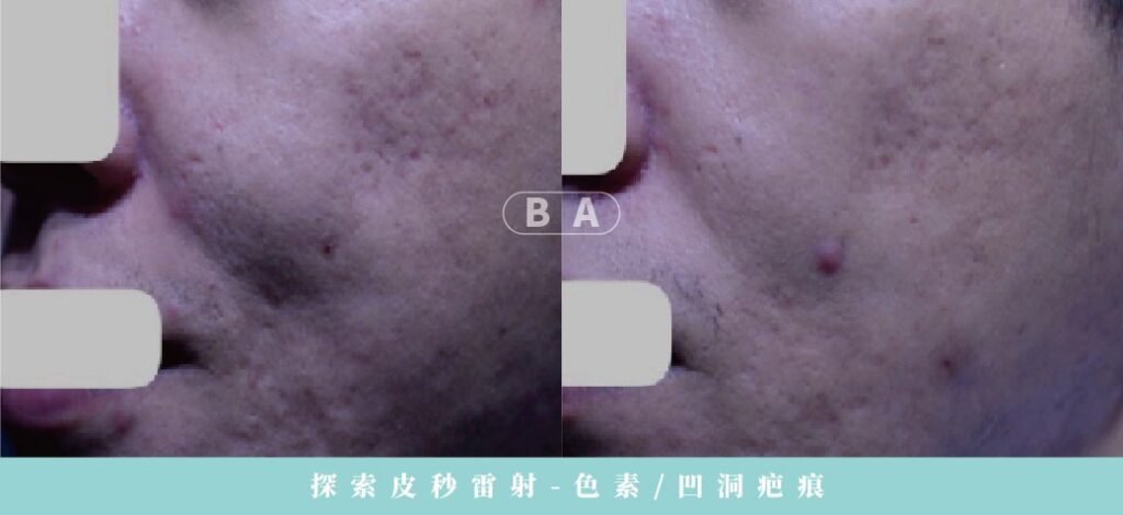 痘疤治療完整指南:型態、成因與最有效的醫美方法 4 皮秒雷射:色素型痘疤首選,輕微凹疤