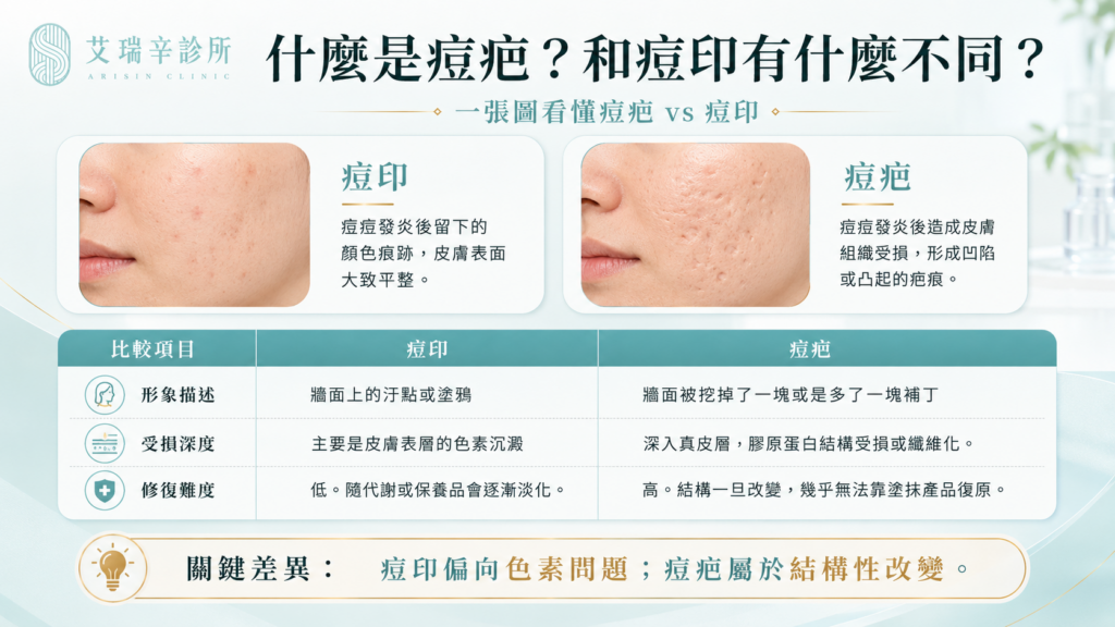 痘疤治療完整指南:型態、成因與最有效的醫美方法 1 什麼是痘疤?和痘印有什麼不同?