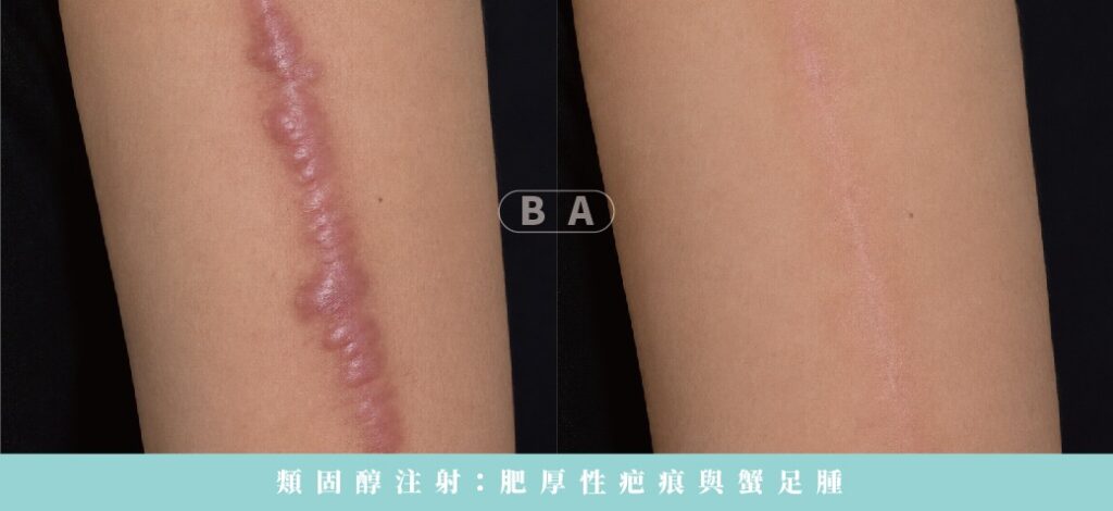 痘疤治療完整指南:型態、成因與最有效的醫美方法 8 類固醇注射:肥厚性疤痕與蟹足腫