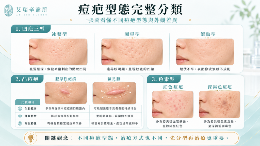痘疤治療完整指南:型態、成因與最有效的醫美方法 2 痘疤型態完整分類