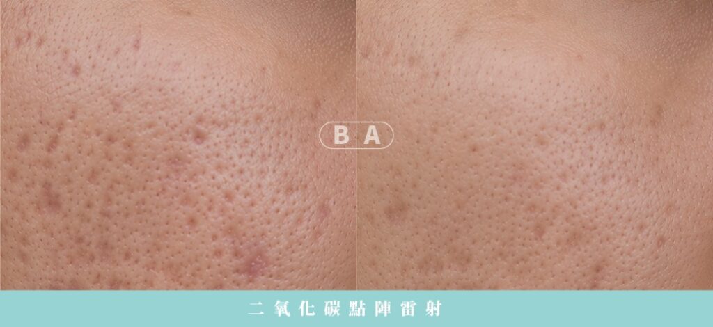 痘疤治療完整指南:型態、成因與最有效的醫美方法 5 二氧化碳點陣雷射:深層凹疤重塑