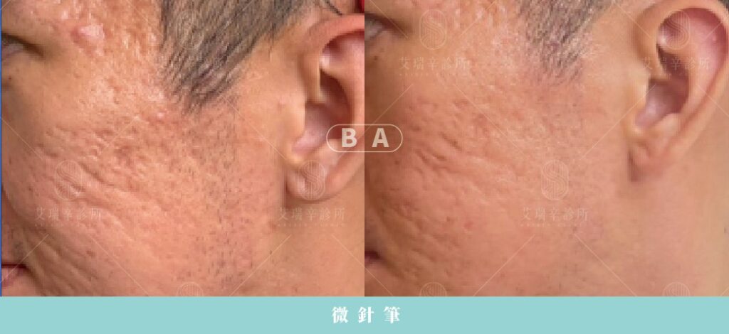 痘疤治療完整指南:型態、成因與最有效的醫美方法 7 微針筆:淺層凹疤與毛孔優化