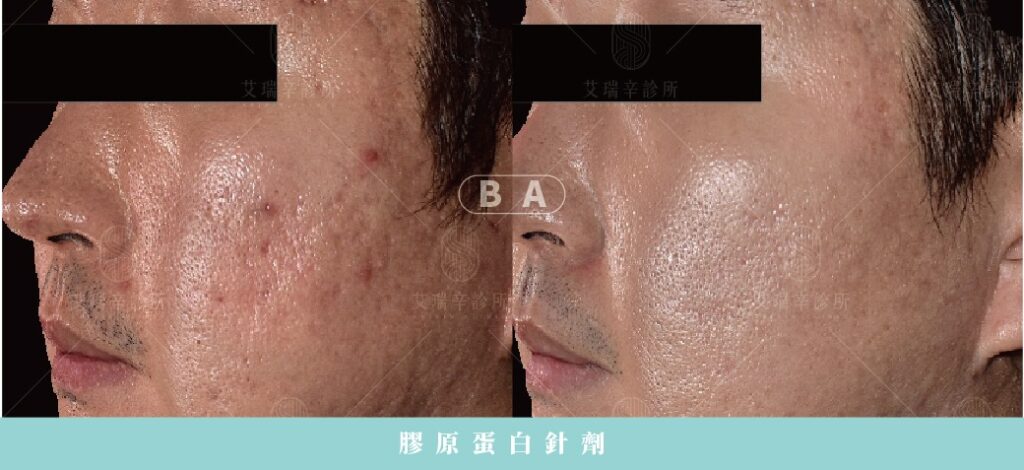 痘疤治療完整指南:型態、成因與最有效的醫美方法 6 膠原蛋白針劑:適合各類凹陷型痘疤(尤其是滾動型)