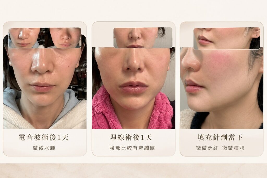 臉下垂醫美拉提完整指南:音波、電波、埋線、肉毒、玻尿酸、膠原蛋白針怎麼選? 22 臉下垂醫美療程術後