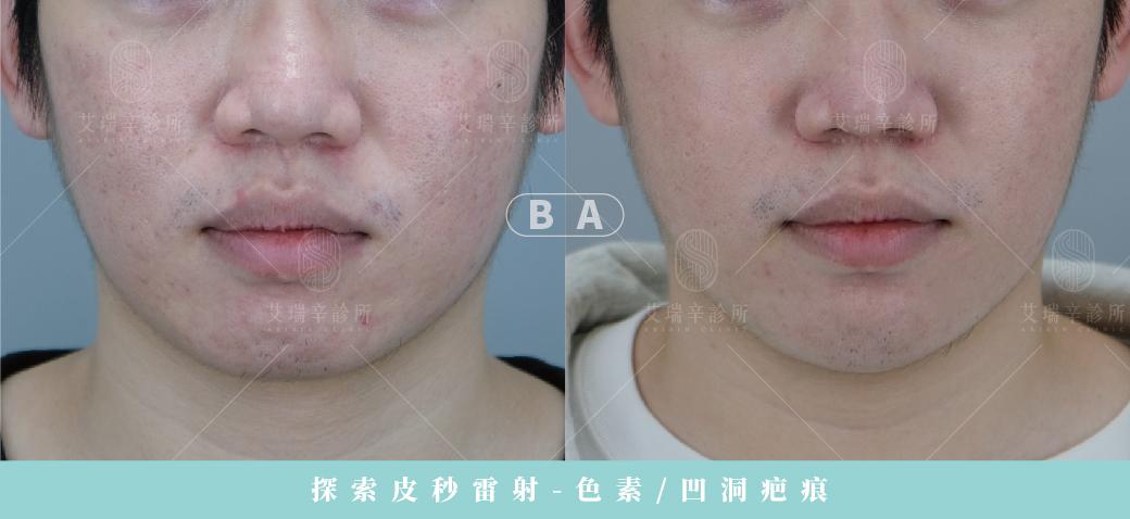 台中痘疤雷射怎麼選?飛梭、皮秒、CO2、UP 雷射哪個更適合你? 10 曾先生痘疤雷射正臉before-after