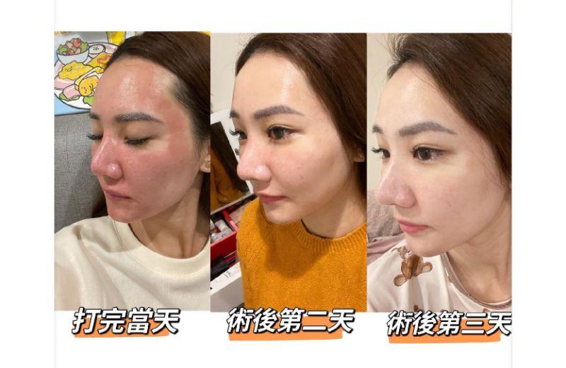 台中痘疤雷射怎麼選?飛梭、皮秒、CO2、UP 雷射哪個更適合你? 4 皮秒雷射術後恢復歷程案例