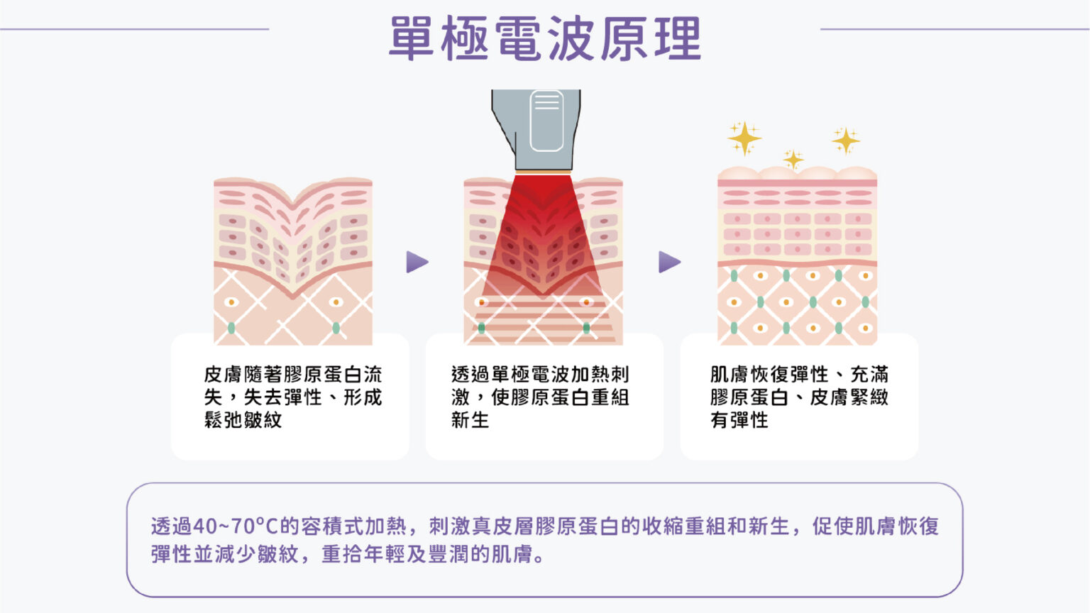 熱門電波拉提比較!詳解十蓓電波和鳳凰電波差別誰更適合你? 4 十蓓電波技術核心與大面積探頭示意圖