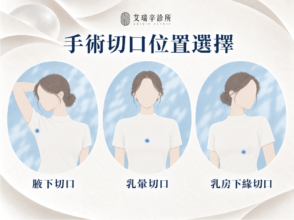 隆乳手術 5 Mentor 工作區域 1 複本 3