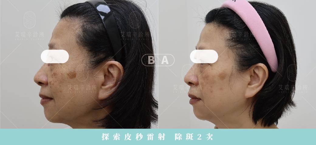 探索皮秒是什麼?跟蜂巢皮秒有什麼差異、術後注意事項一次看 2 探索皮秒雷射除斑2次治療前後對比-側面