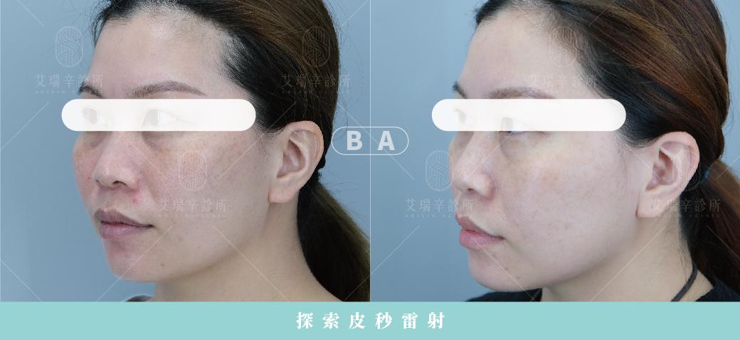 皮秒雷射多久看到效果?原理、影響因素與術後保養全解析 3 皮秒雷射除斑治療前後對比案例-側面