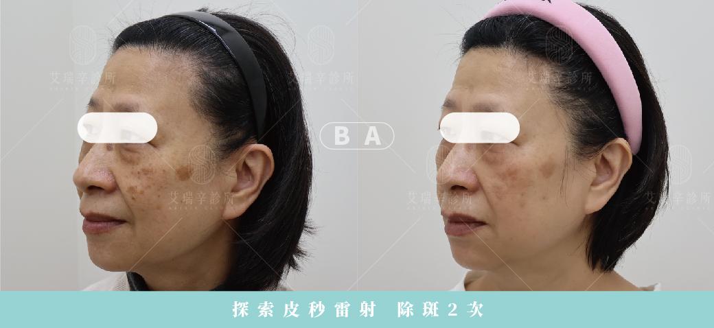探索皮秒是什麼?跟蜂巢皮秒有什麼差異、術後注意事項一次看 3 探索皮秒雷射除斑2次治療前後對比-正面