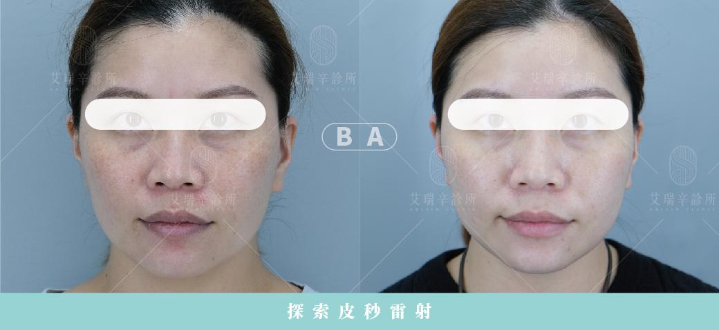 皮秒雷射多久看到效果?原理、影響因素與術後保養全解析 4 皮秒雷射除斑治療前後對比案例-正面