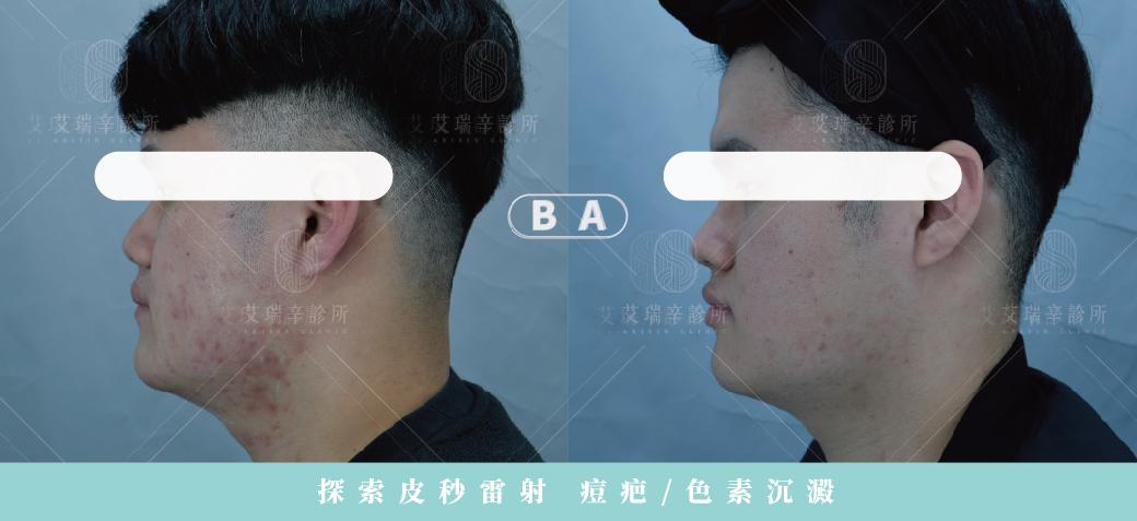 探索皮秒是什麼?跟蜂巢皮秒有什麼差異、術後注意事項一次看 4 探索皮秒雷射改善痘疤色素沉澱治療前後對比-側面