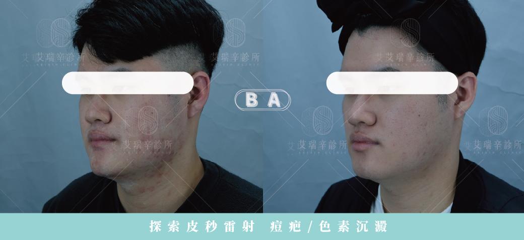 探索皮秒是什麼?跟蜂巢皮秒有什麼差異、術後注意事項一次看 5 探索皮秒雷射改善痘疤色素沉澱治療前後對比-正面